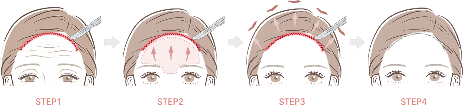 前額リフトとは