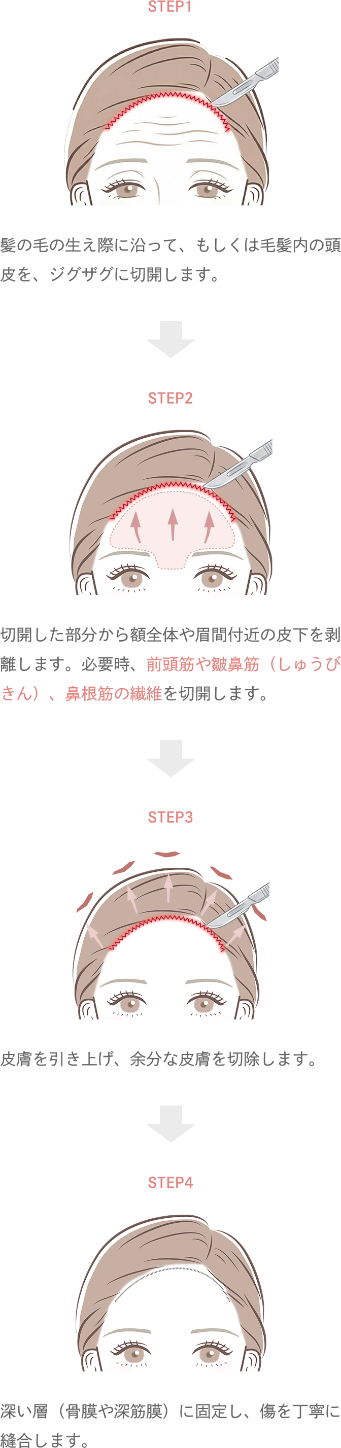 前額リフトとは