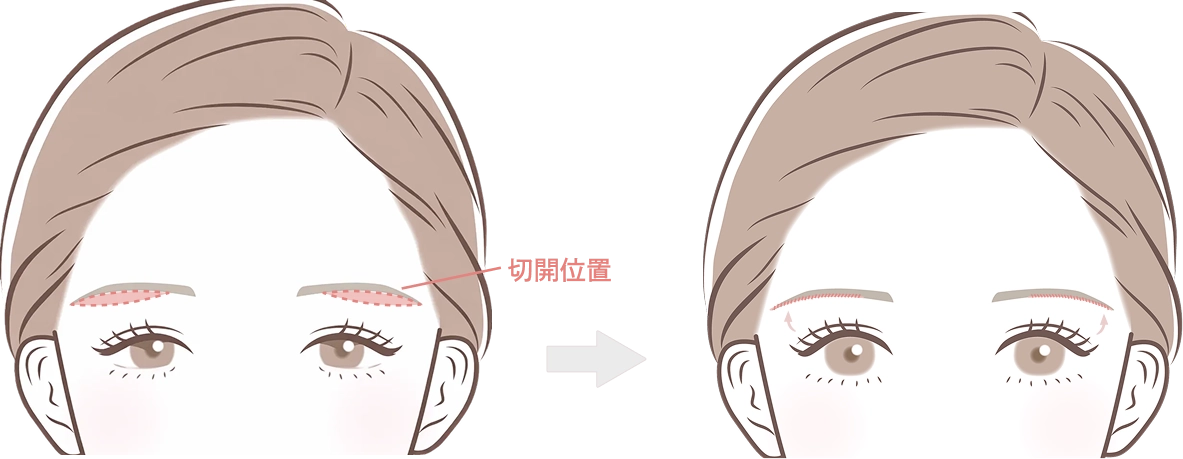 眉下切開