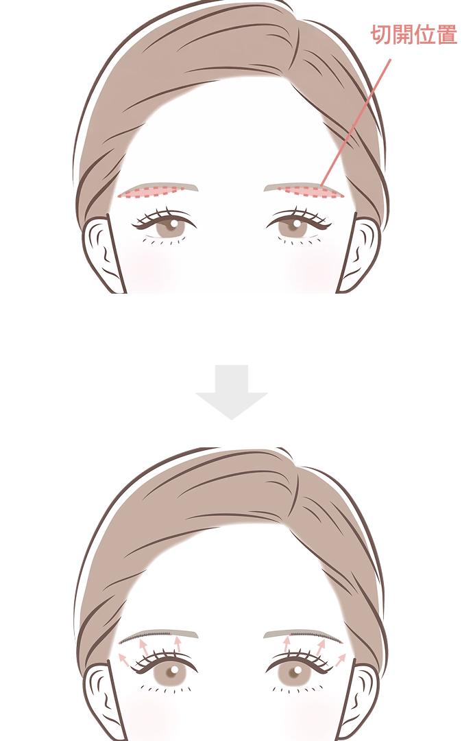 眉下切開