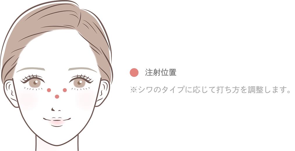 バニーラインのボトックス注射とは