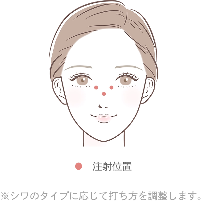 バニーラインのボトックス注射とは