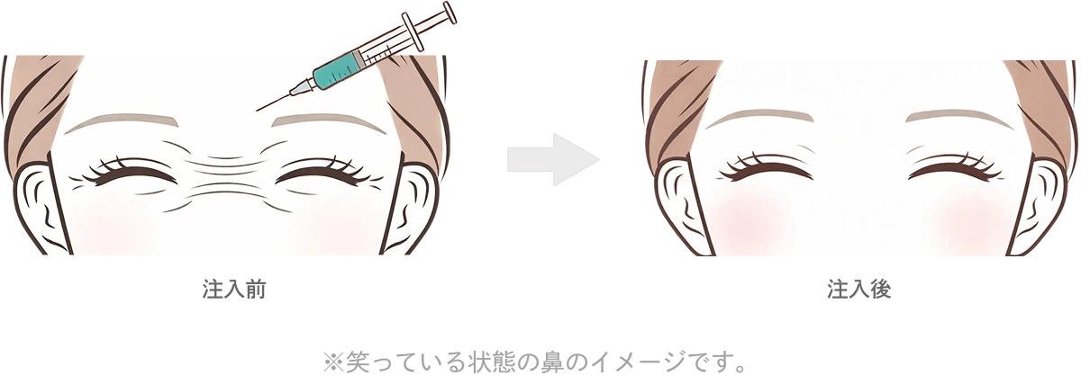 バニーラインのボトックス注射の効果