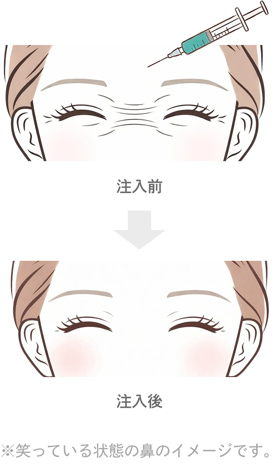 バニーラインのボトックス注射の効果