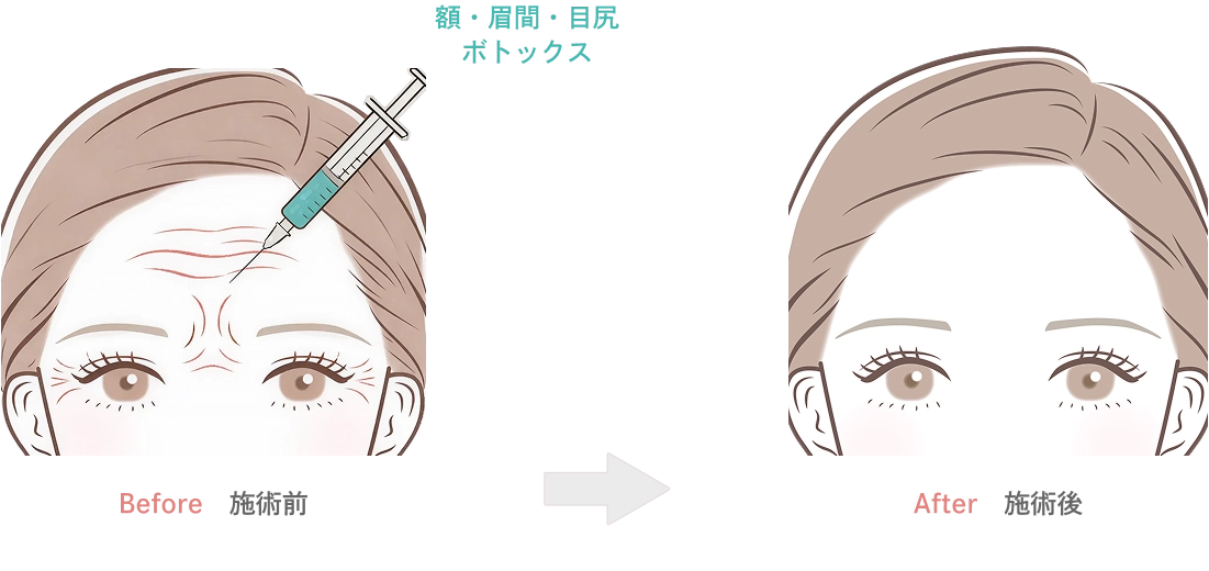 額・眉間・目尻のボトックス注射