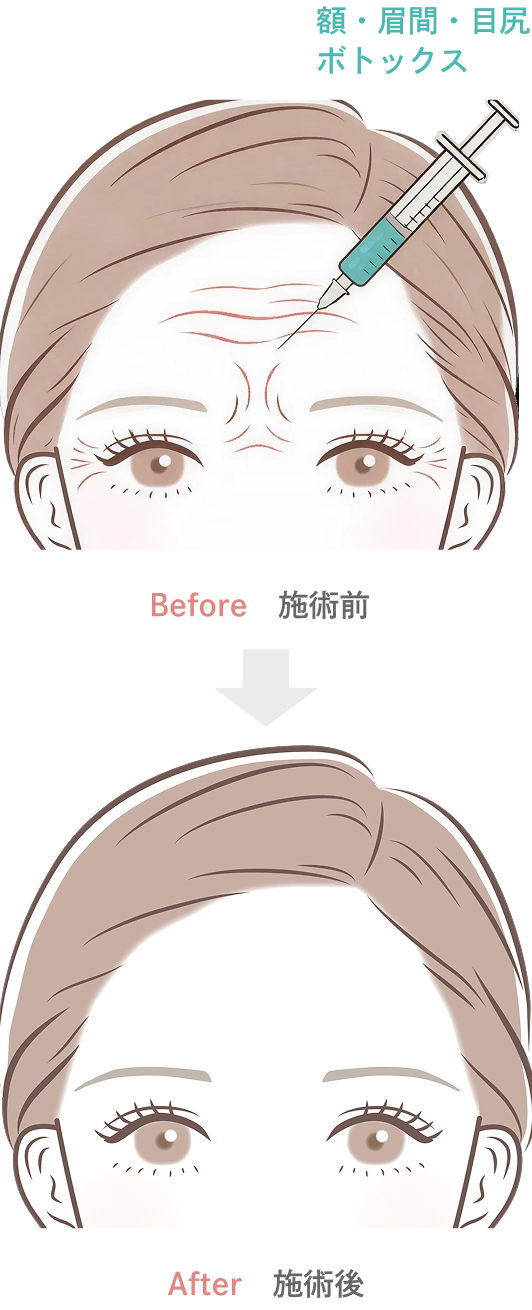 額・眉間・目尻のボトックス注射