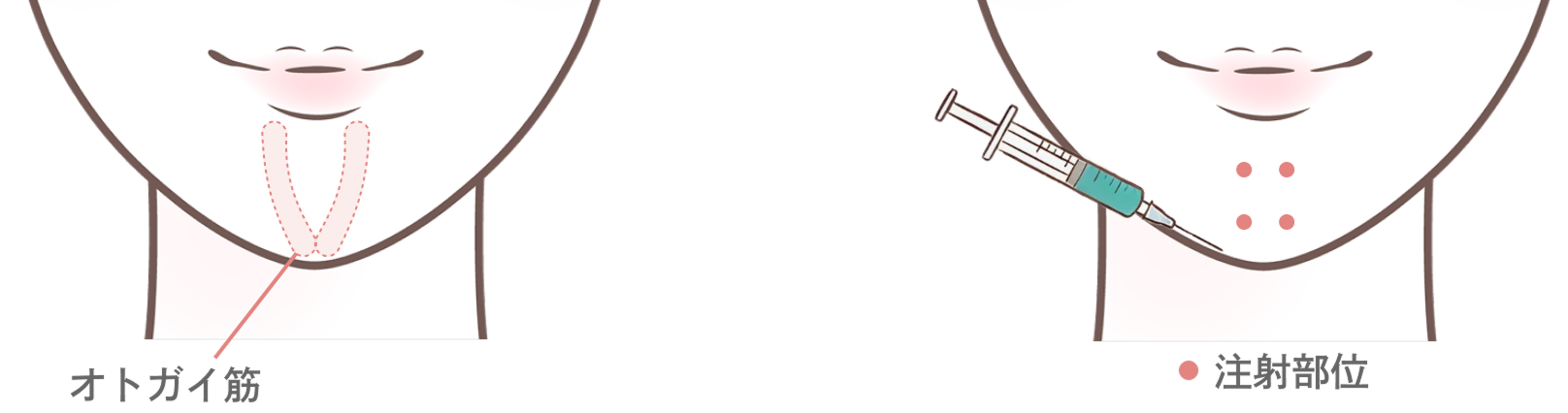 額・眉間・バニーラインのボトックス注射とは