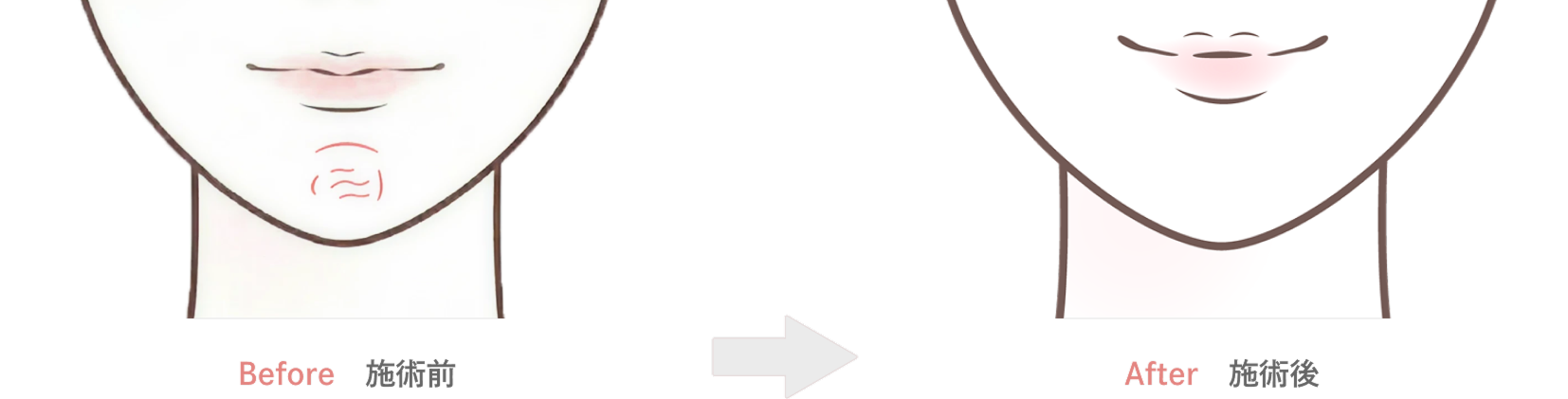 顎のボトックス注射の効果