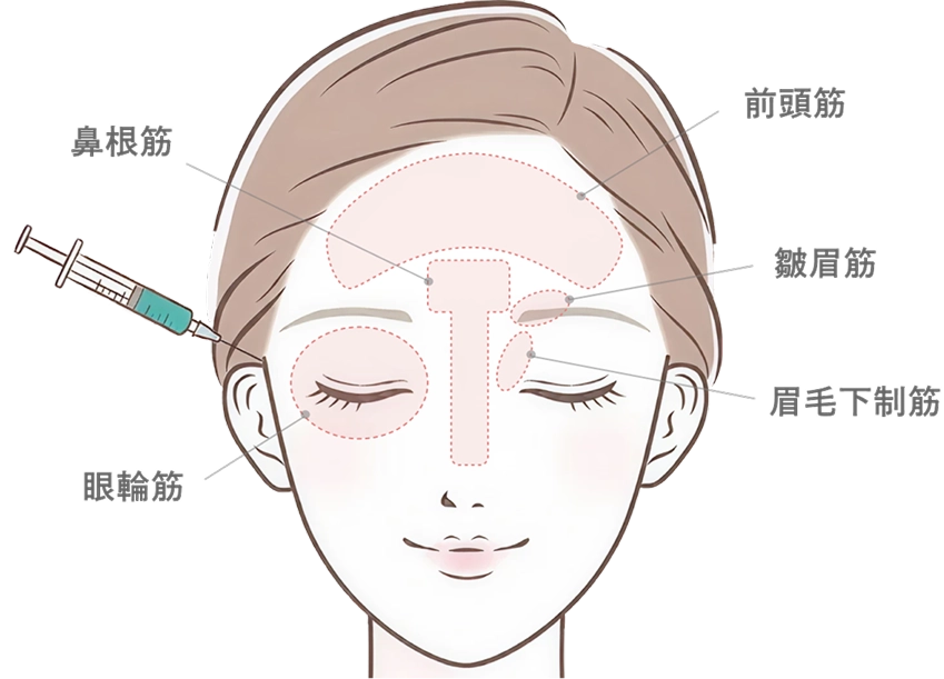 額・眉間・目尻のボトックス注射とは