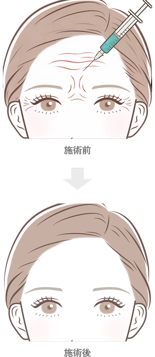 額・眉間・目尻のボトックス注射の効果