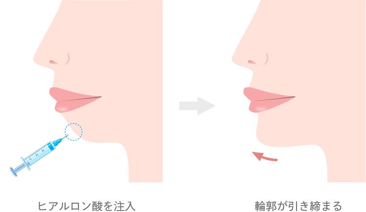 顎のヒアルロン酸注入とは
