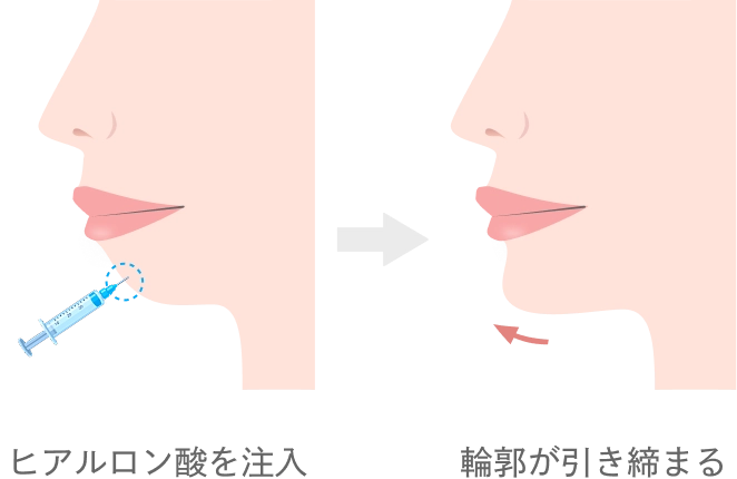顎のヒアルロン酸注入とは