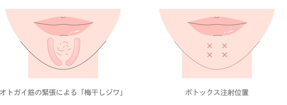 顎のボトックス注射