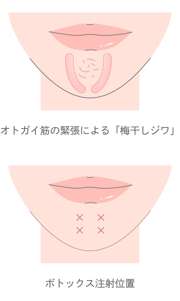 顎のボトックス注射