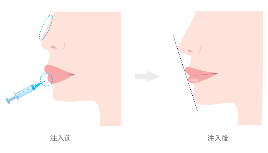 鼻・唇のヒアルロン酸注入
