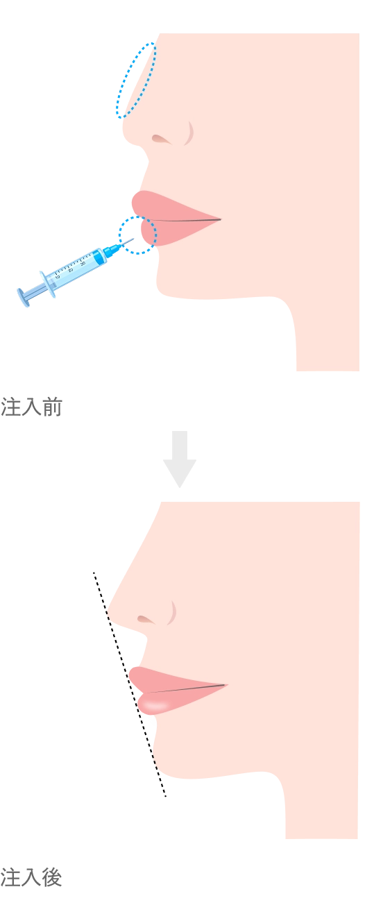 鼻・唇のヒアルロン酸注入