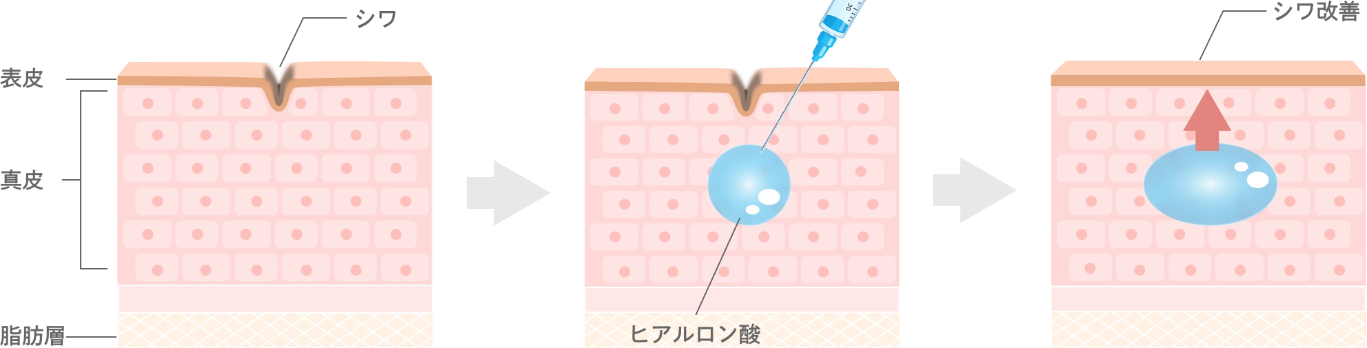 ヒアルロン酸注入とは
