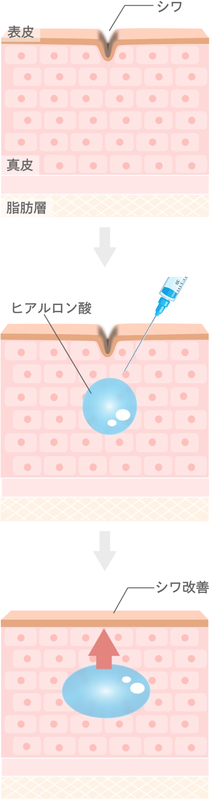 ヒアルロン酸注入とは