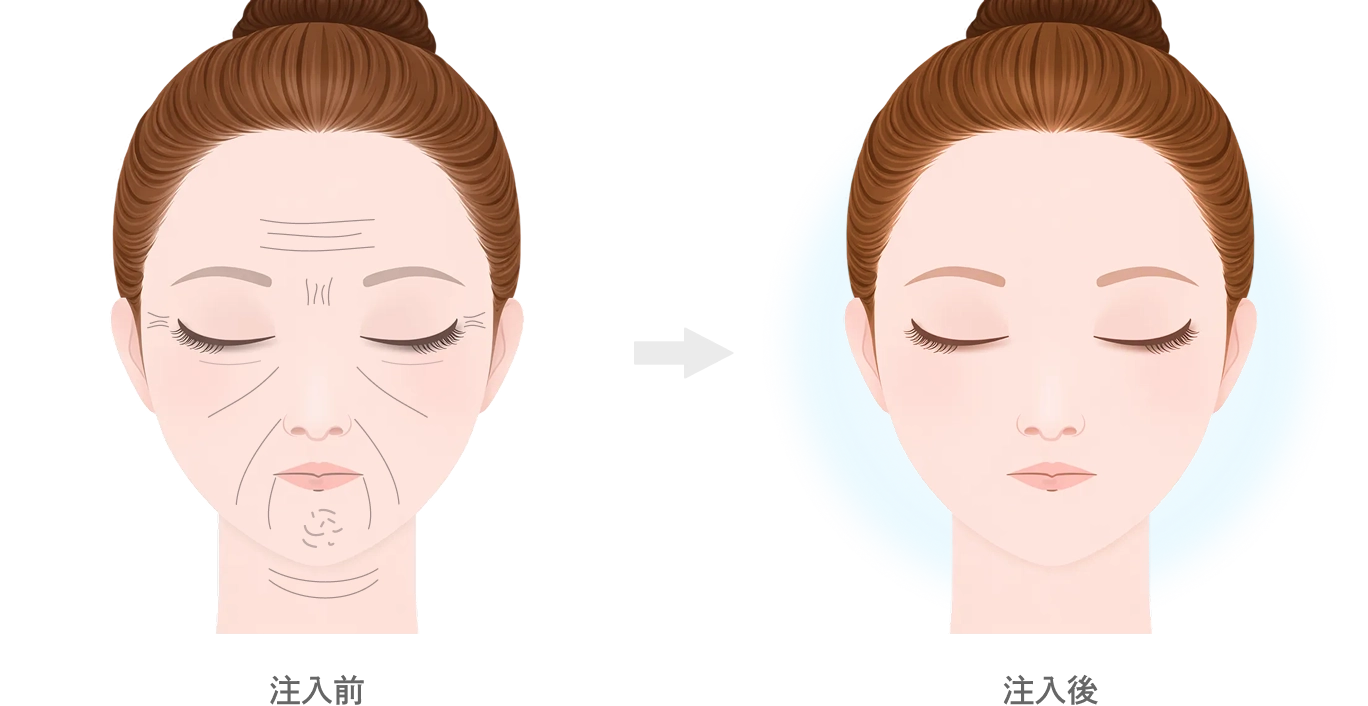 ヒアルロン酸注入の効果
