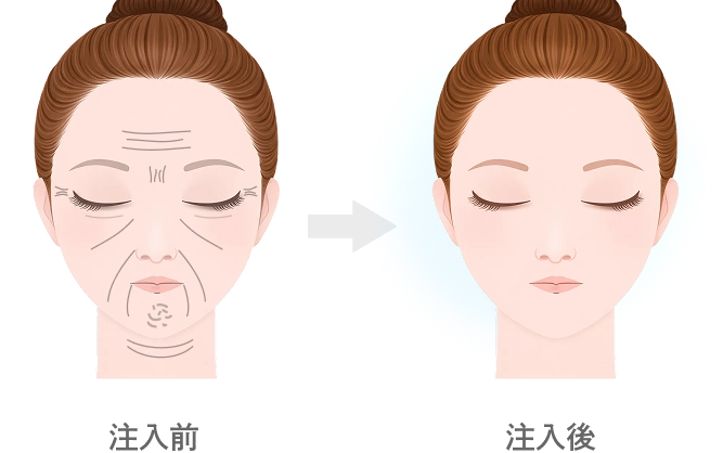 ヒアルロン酸注入の効果