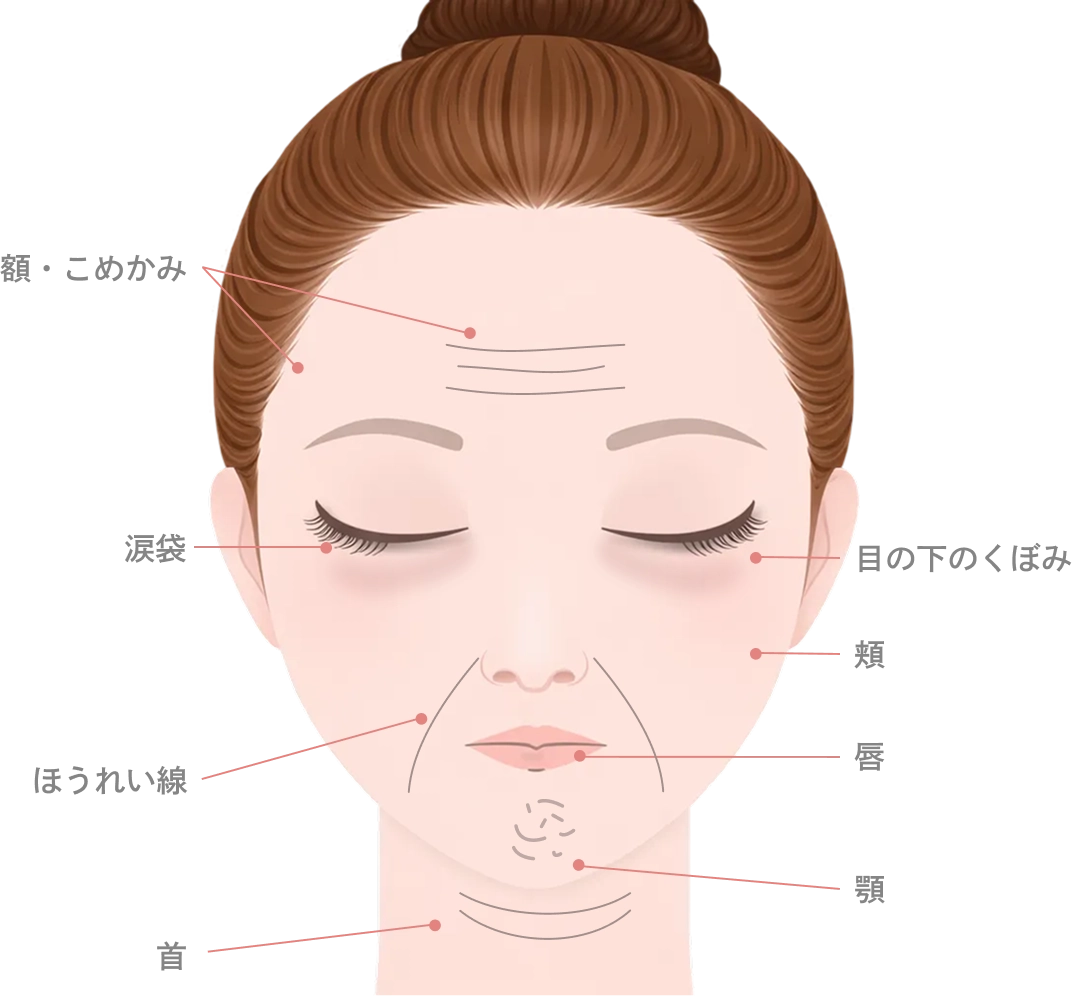 ボツリヌストキシン治療