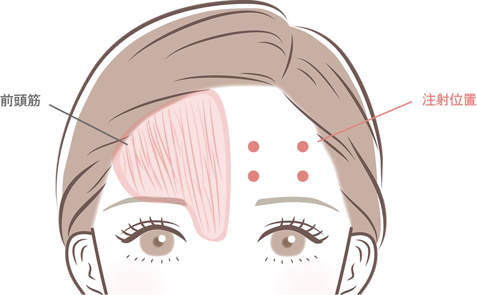 額のボトックス注射