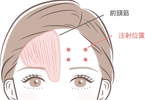 額のボトックス注射