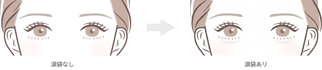 涙袋のヒアルロン酸注入