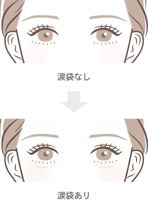 涙袋のヒアルロン酸注入