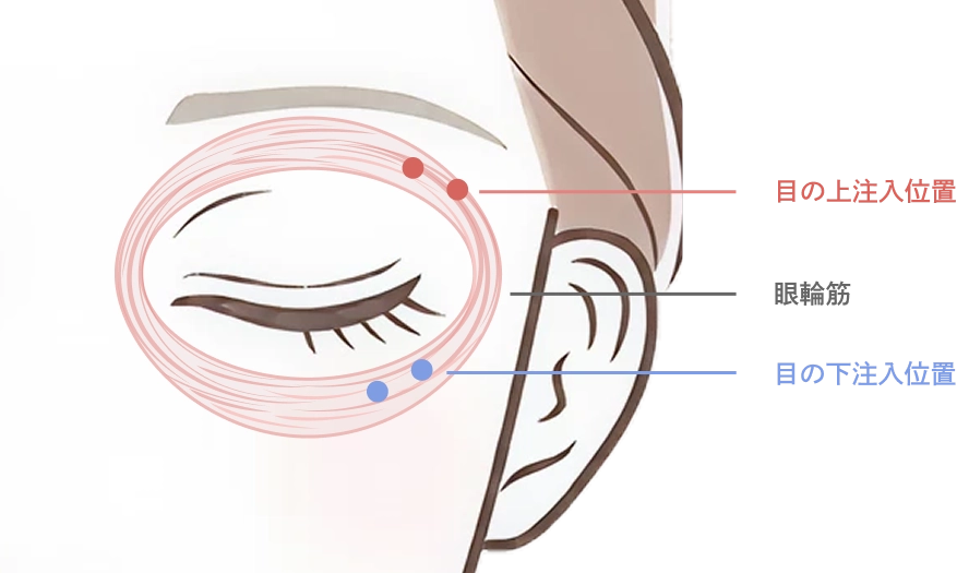 目デカボトックス注射とは