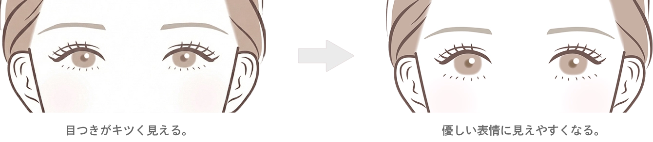 目デカボトックス注射の効果