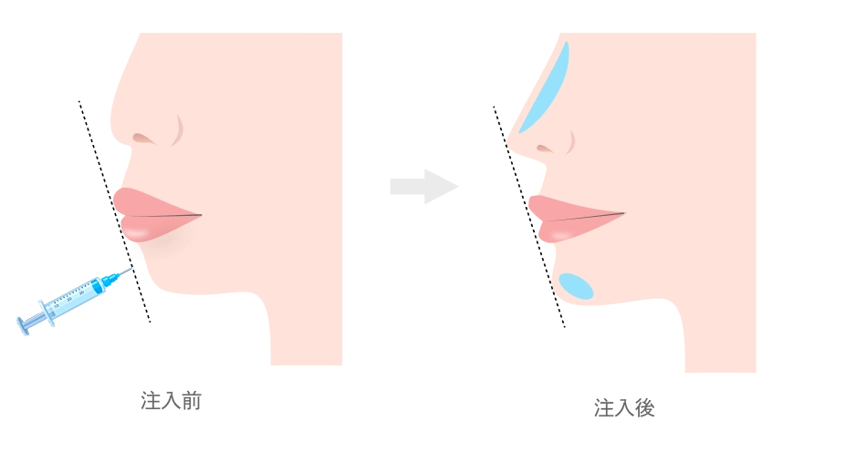 顎・鼻のヒアルロン酸注入