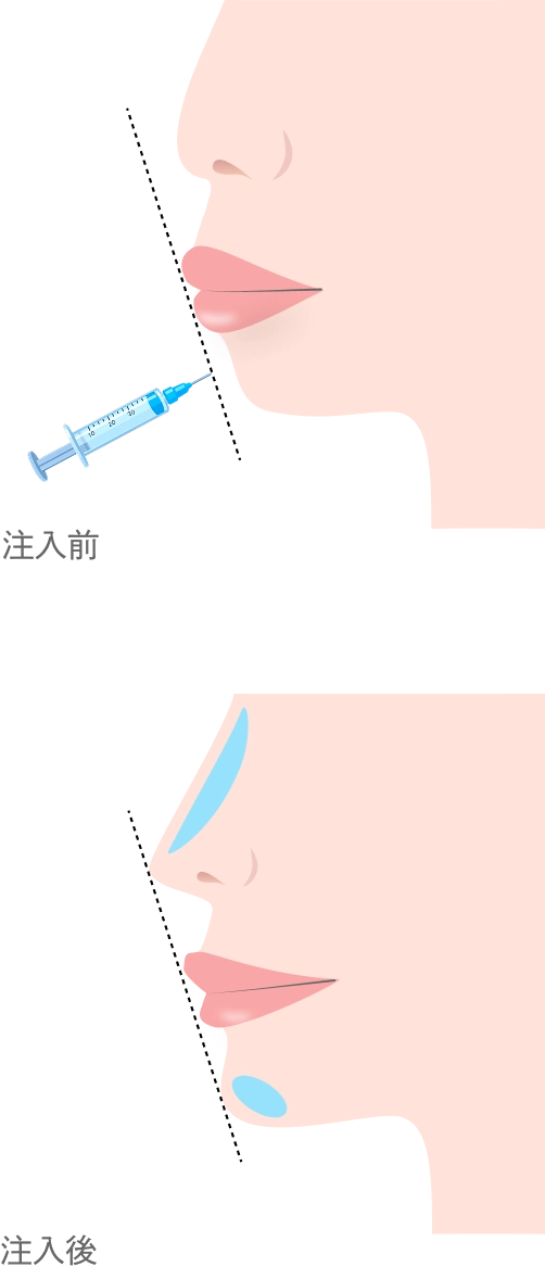 顎・鼻のヒアルロン酸注入