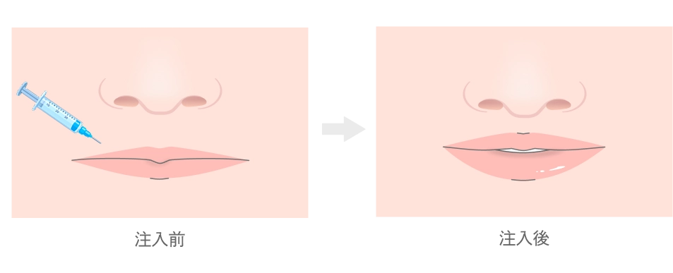 唇のヒアルロン酸注入とは