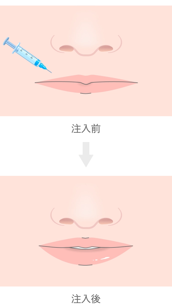 唇のヒアルロン酸注入とは