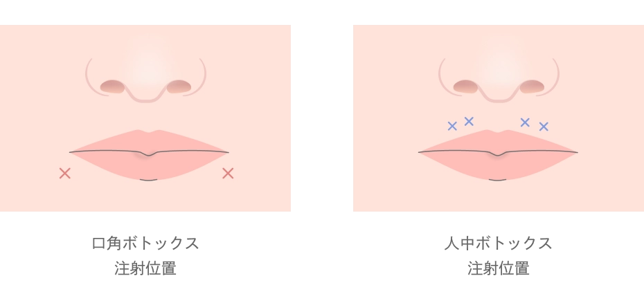 口角・人中のボトックス注射