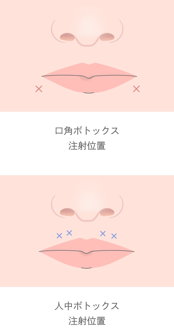口角・人中のボトックス注射