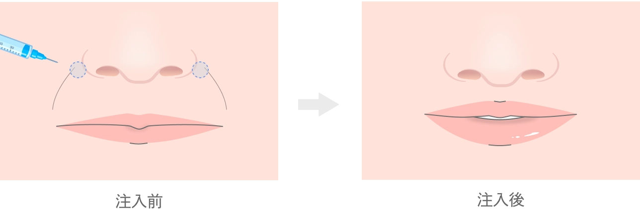 貴族注射（鼻翼基部へのヒアルロン酸注入）
