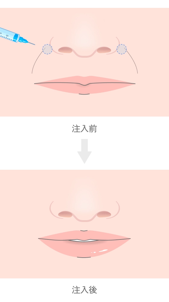 貴族注射（鼻翼基部へのヒアルロン酸注入）