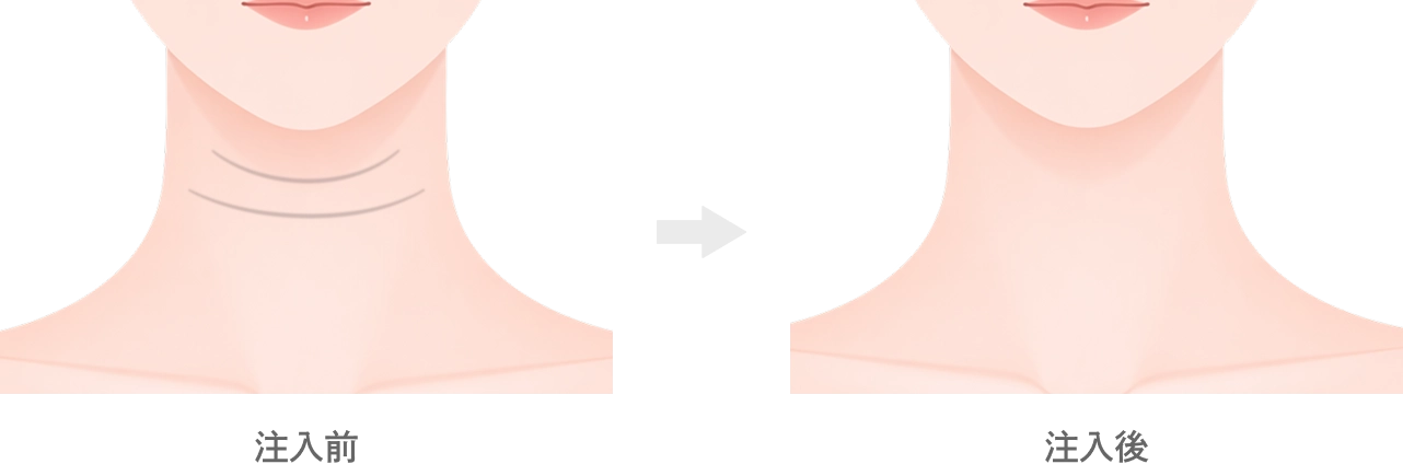 首のヒアルロン酸注入とは