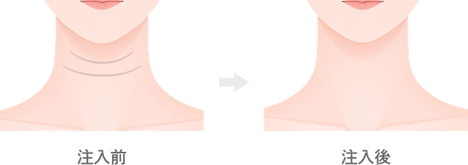 首のヒアルロン酸注入とは