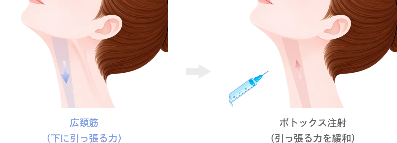広頚筋のボトックス注射