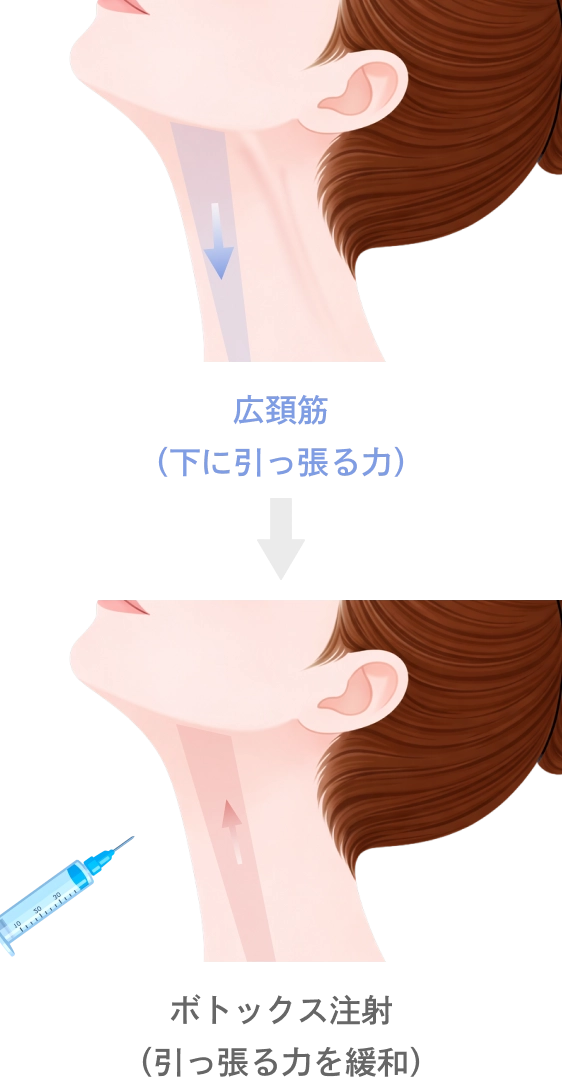 広頚筋のボトックス注射