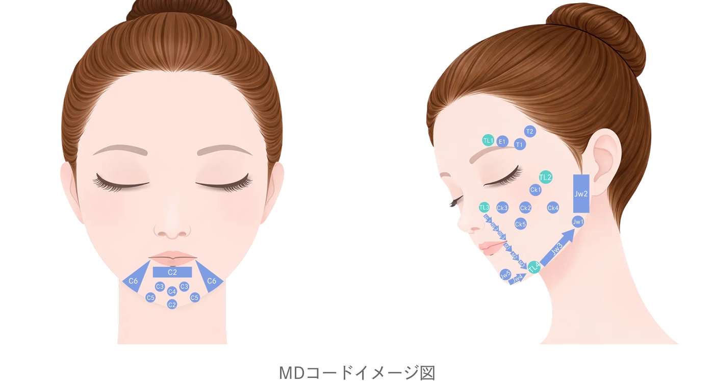 貴族注射（鼻翼基部へのヒアルロン酸注入）