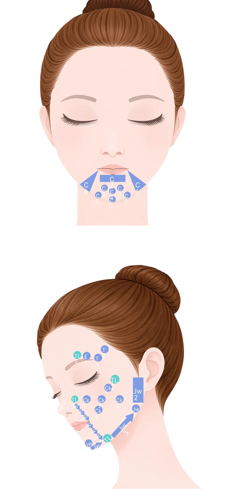 貴族注射（鼻翼基部へのヒアルロン酸注入）