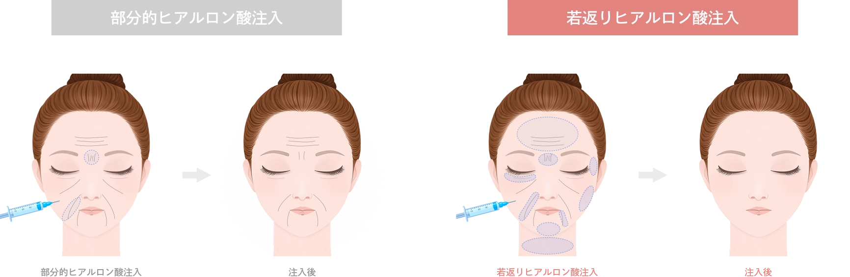 若返りのヒアルロン酸が選ばれる理由