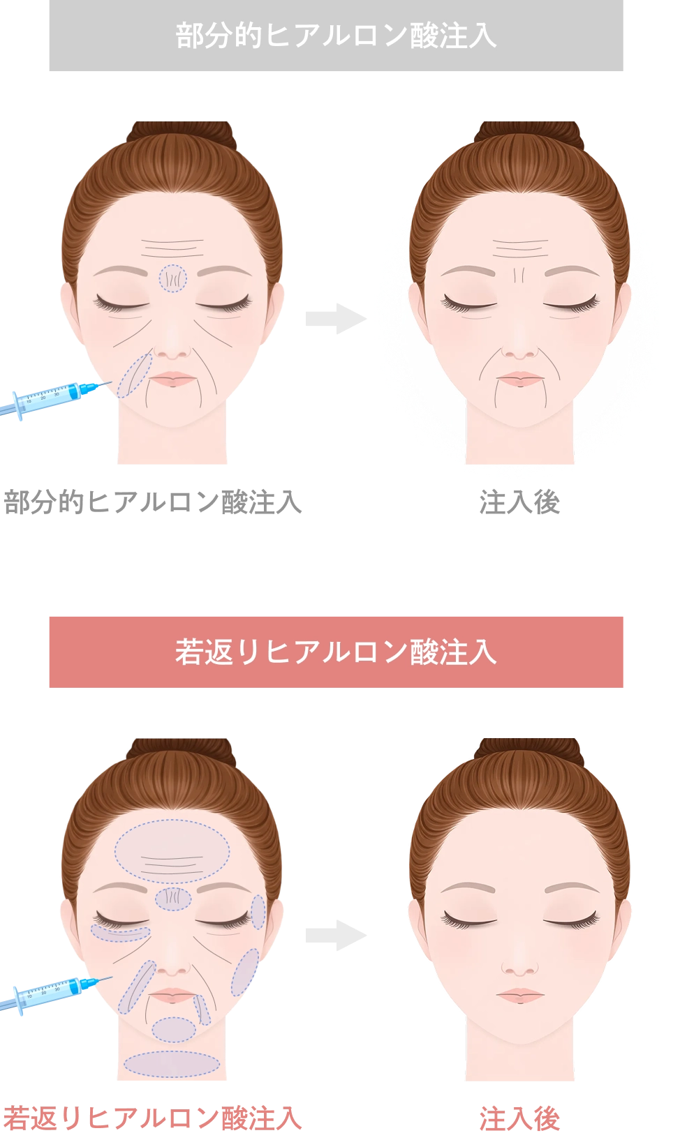 若返りのヒアルロン酸が選ばれる理由