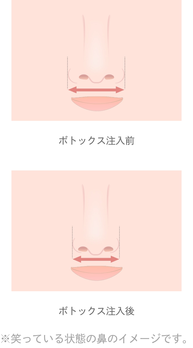 小鼻のボトックス注射の効果