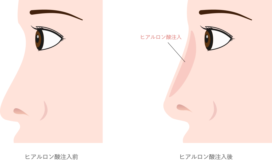 鼻のヒアルロン酸注入