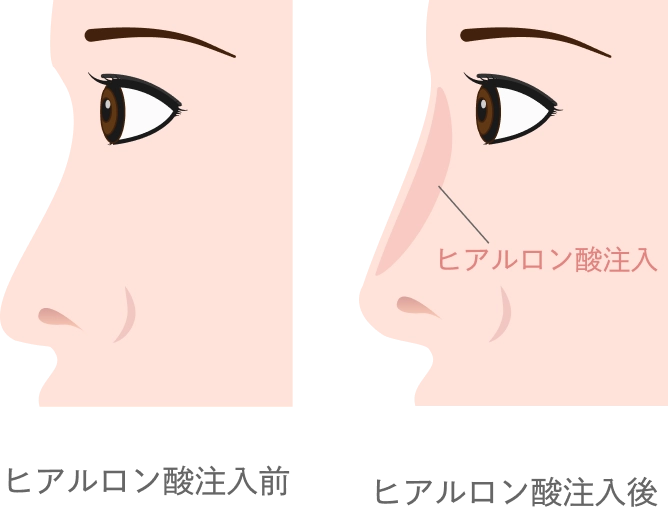 鼻のヒアルロン酸注入